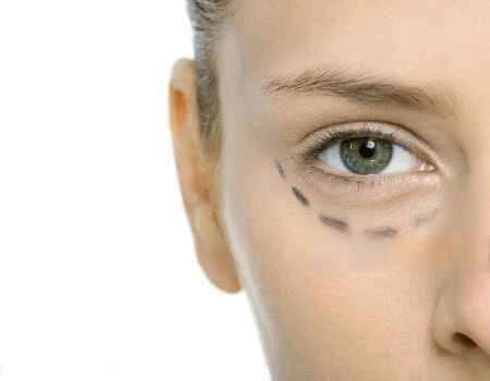 dark circle laser treatment cost